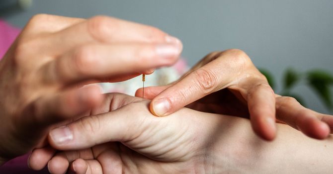 Understanding Acupuncture: Debunking Common Myths image