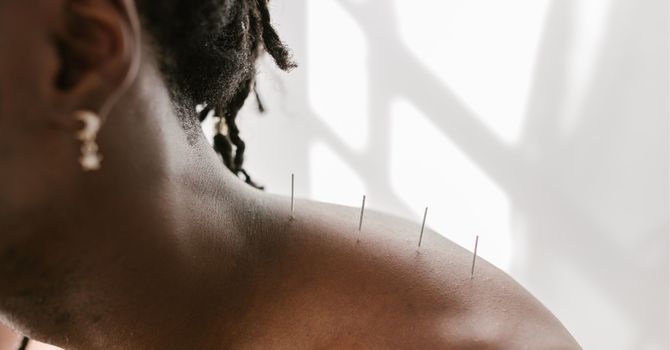 Understanding Acupuncture: Debunking Common Myths