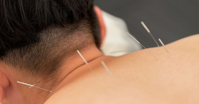 How Acupuncture for Anxiety Can Help Calm Your Nervous System